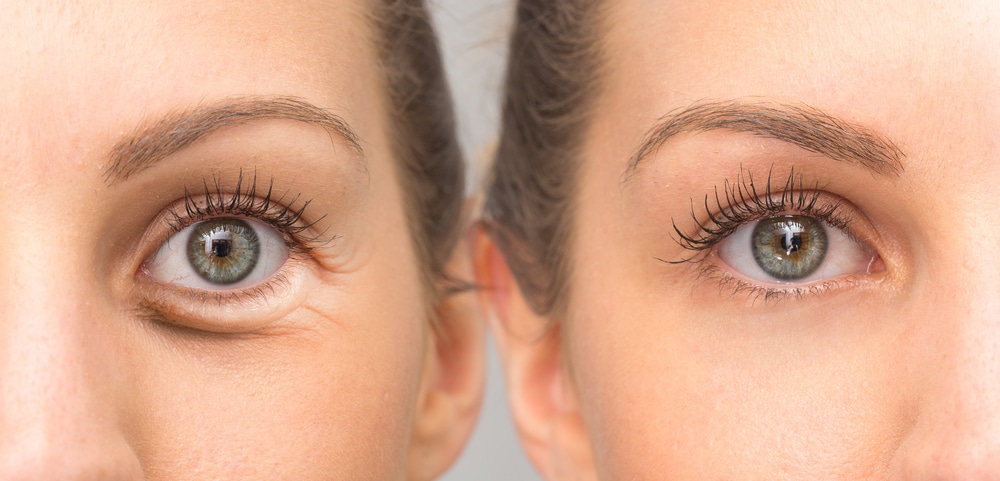 Blepharoplasty Eyelid Surgery Cost in India  Hospitals  Cities