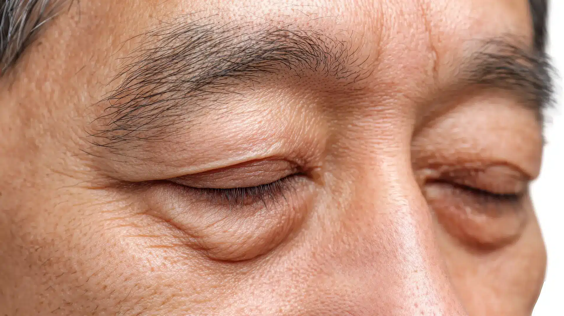 Ptosis Surgery Singapore: Droopy Eyelid Surgery